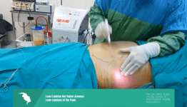  Laser lipolizle bel yağları alınması