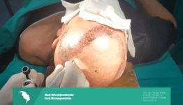Lazer lipolizle gıdı yağları azaltılması