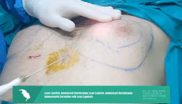 Lazer Lipolizle Jinekomasti Korreksiyonu