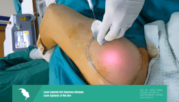  Lazer lipolizle kol yağlarının alınması